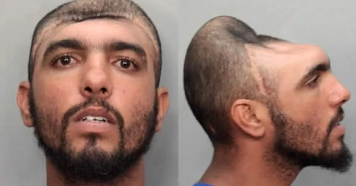 Como Carlos Rodríguez vive sem metade do cérebro