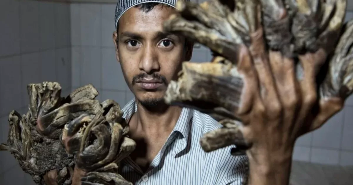 Homem está virando "árvore" por causa de doença rara