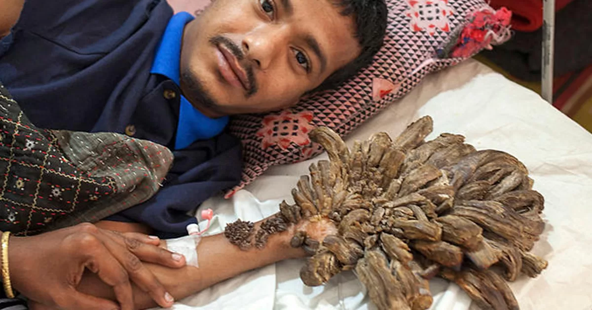 Homem está virando "árvore" por causa de doença rara